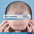 Hair transplant and some techniques that are used in that